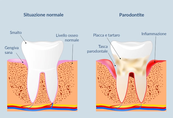 parodontite